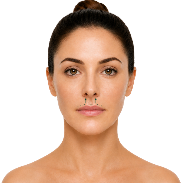 Liplift