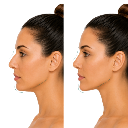 Cirugía de Perfil facial