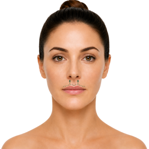 Liplift